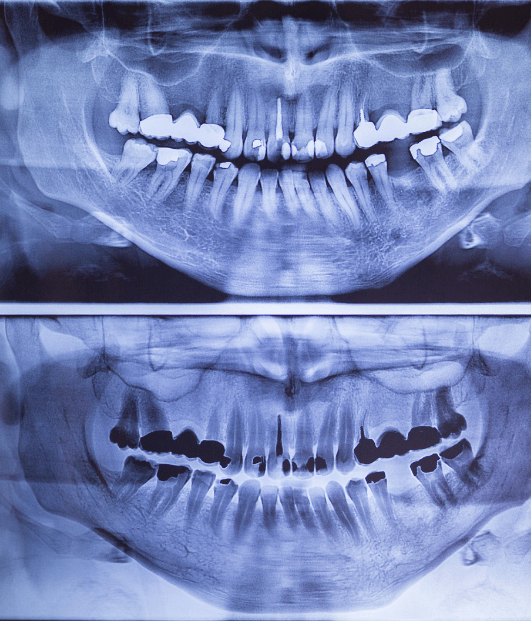 Panoramic Radiographs Digital XRays in Belton, TX Cure Dental