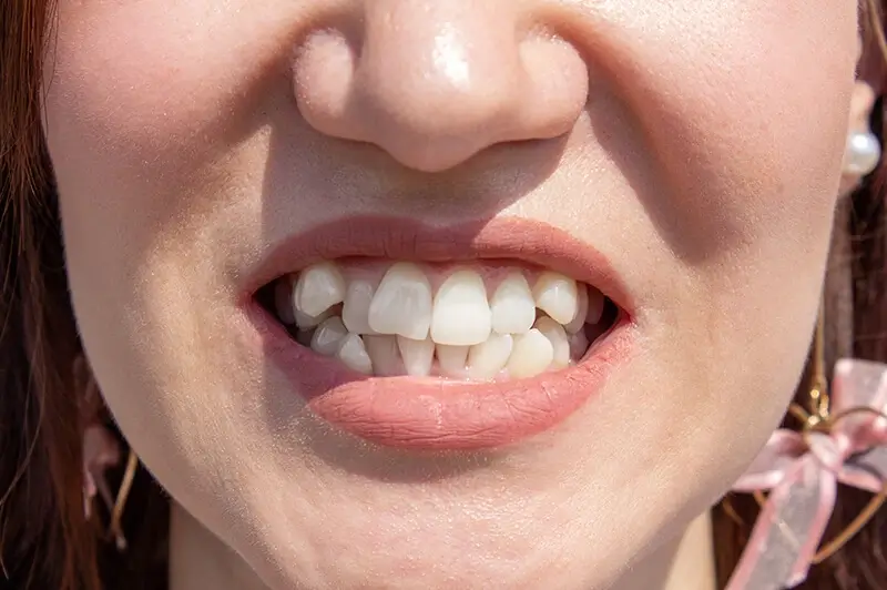 malocclusion of the teeth