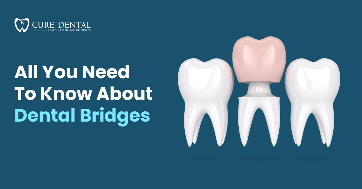 All You Need To Know About Dental Bridges