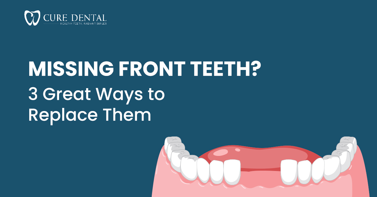 Missing Front Teeth? 3 Great Ways to Replace Them
