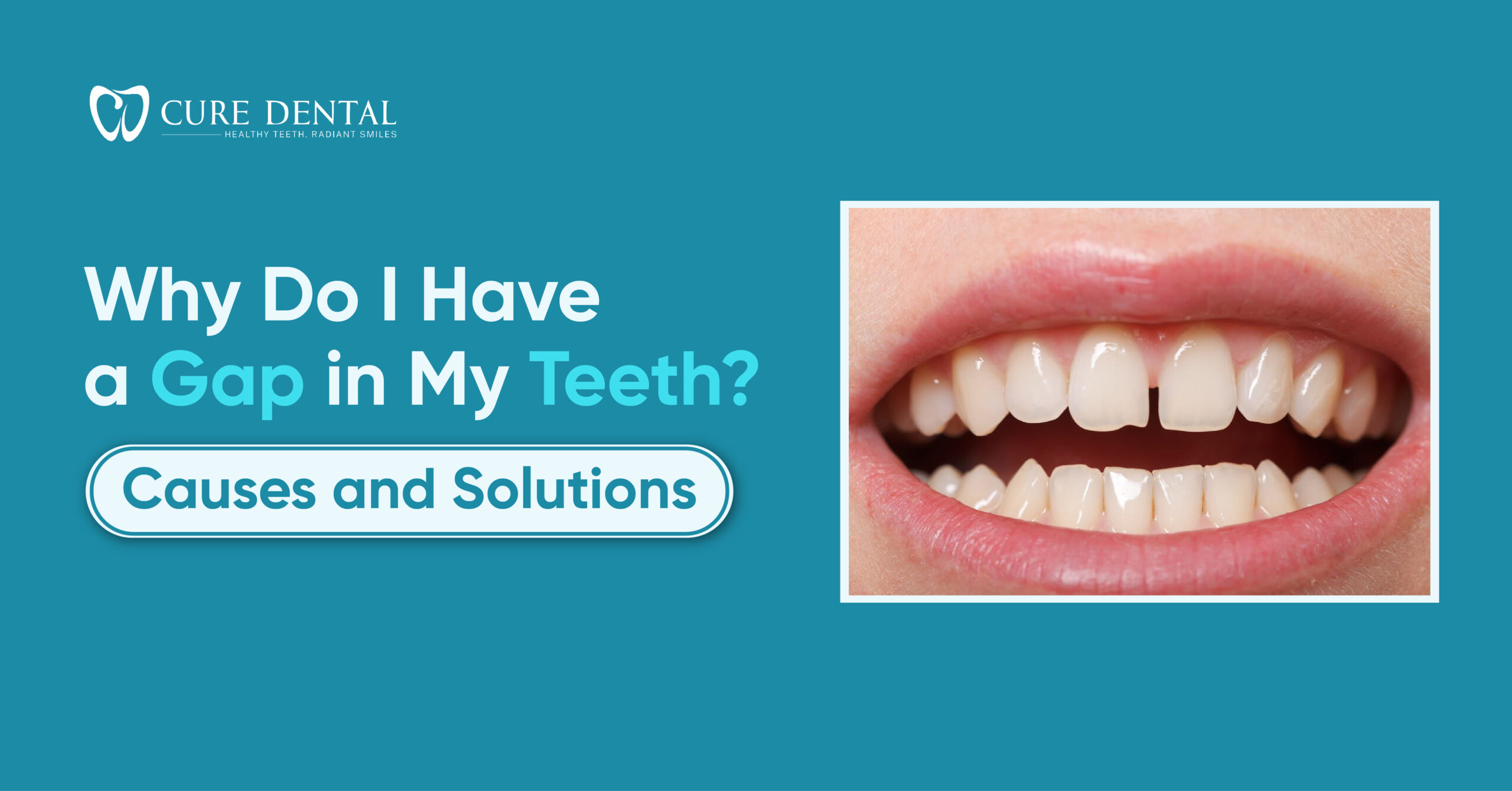 gap-in-teeth-causes-solutions