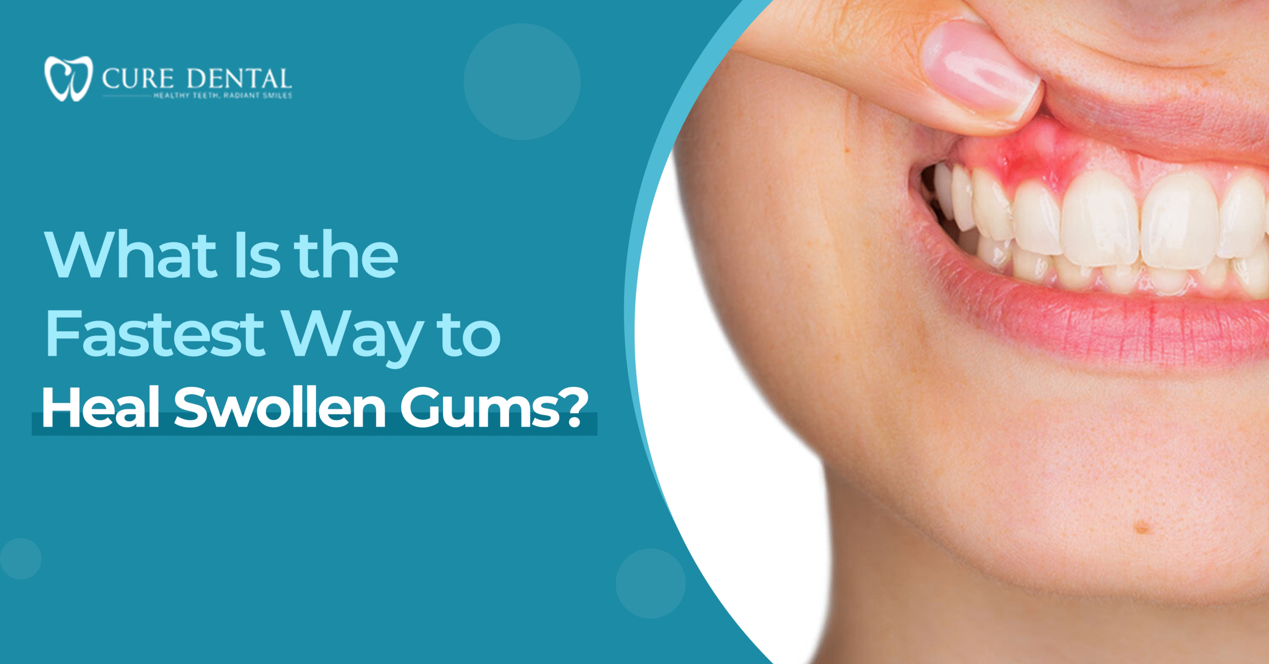 What Is The Fastest Way To Heal Swollen Gums