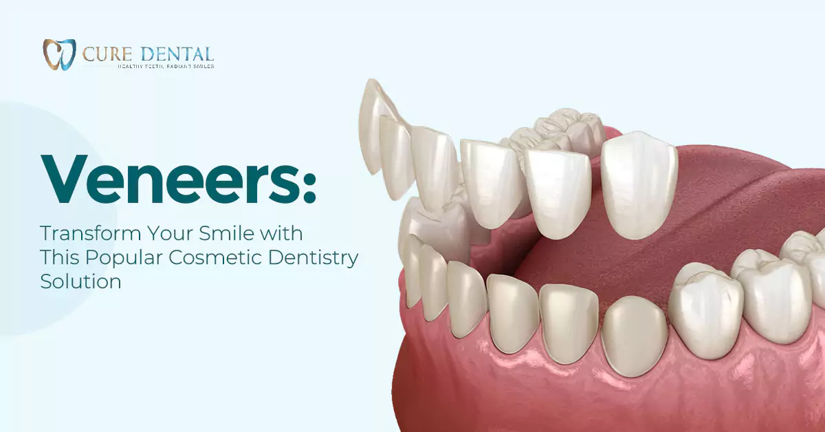 Veneers: Transform Your Smile with This Popular Cosmetic Dentistry Solution