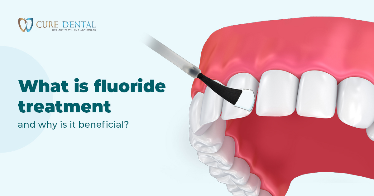 What is Fluoride Treatment, and Why is it Beneficial?