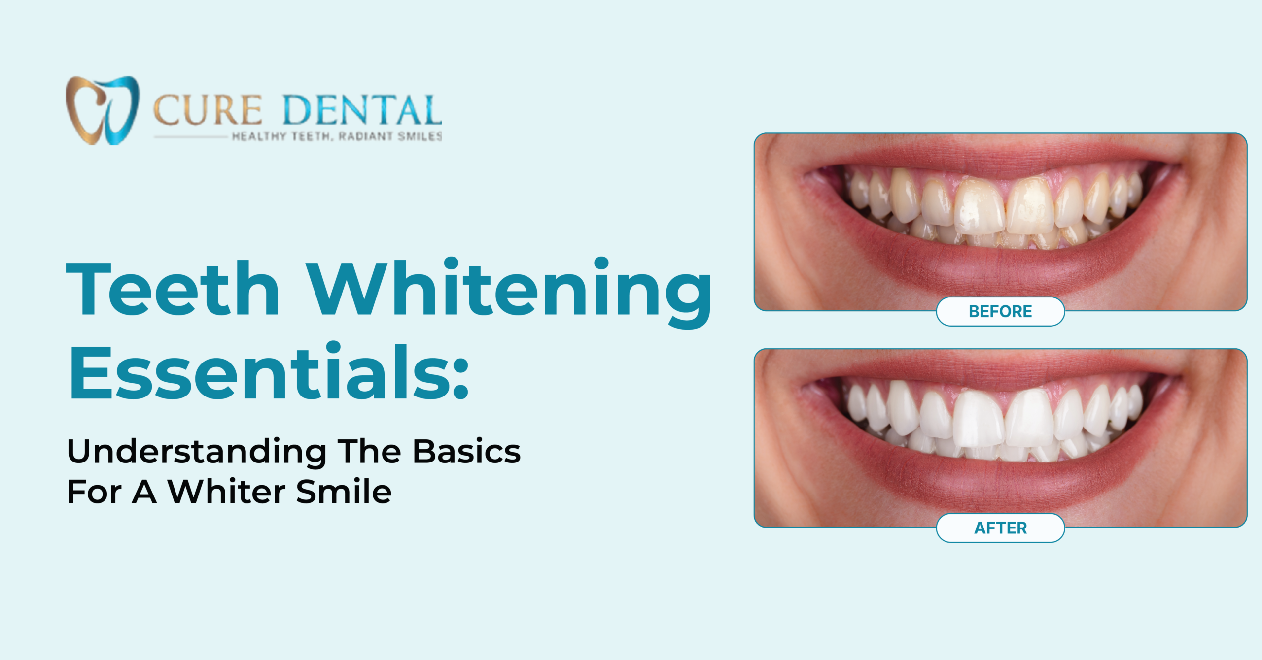 Teeth Whitening Essentials Understanding the Basics for a Whiter Smile